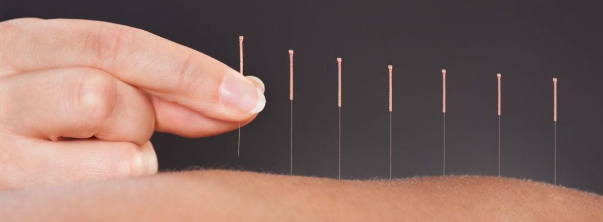 Acupuncture